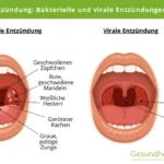 Mandelentzündung