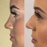 Kosten für Rhinoplastik weltweit