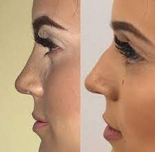 Kosten für Rhinoplastik weltweit